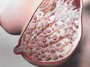 mastitis breast anatomy