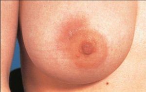breast mastitis