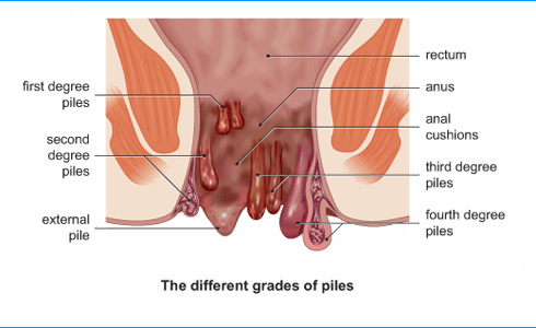 Haemorrhoids During Pregnancy Prevention And Treatment